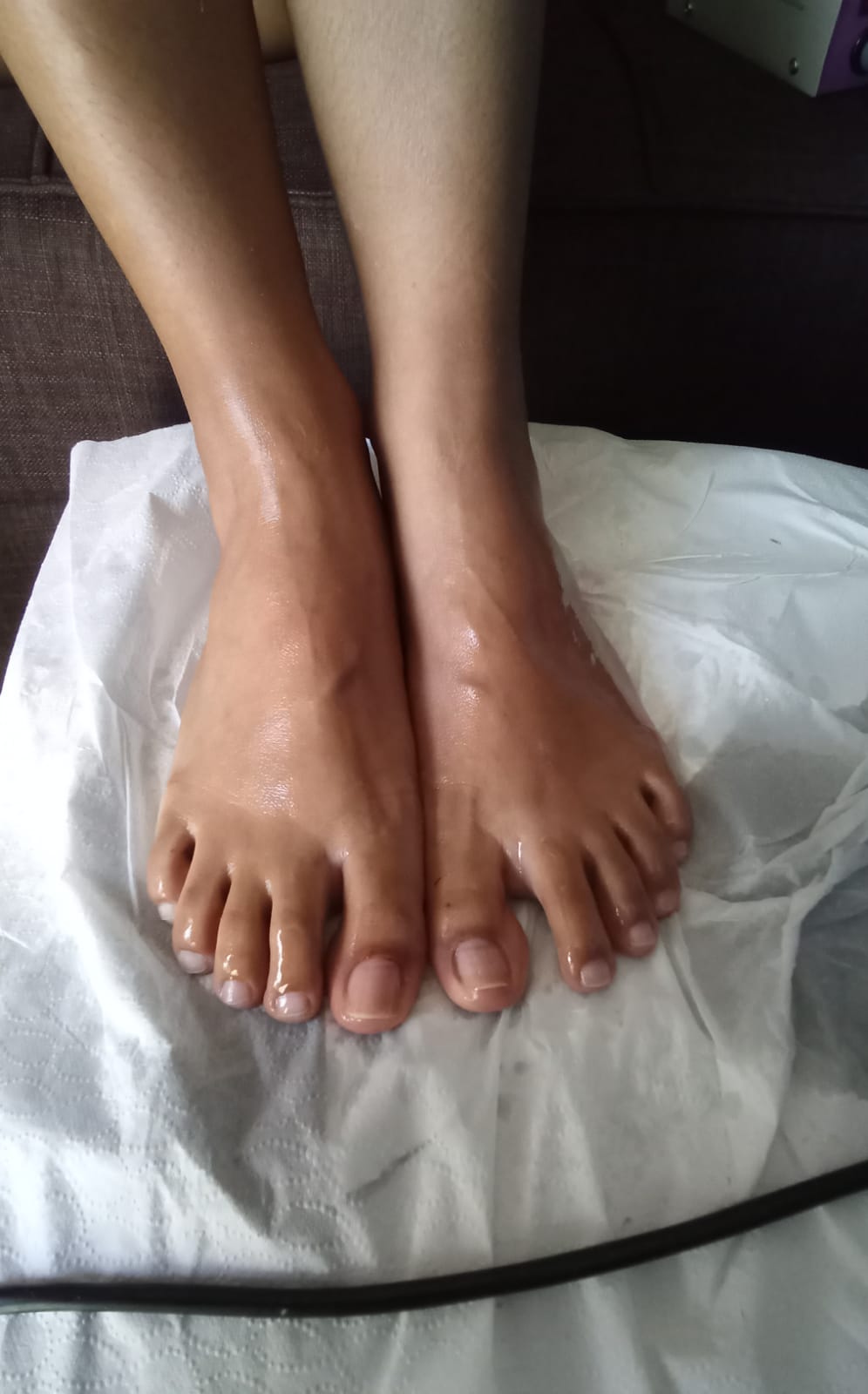 Después - Tratamiento 2